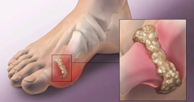 How To Help Naturally Reverse Gout And Relieve Joint Pain