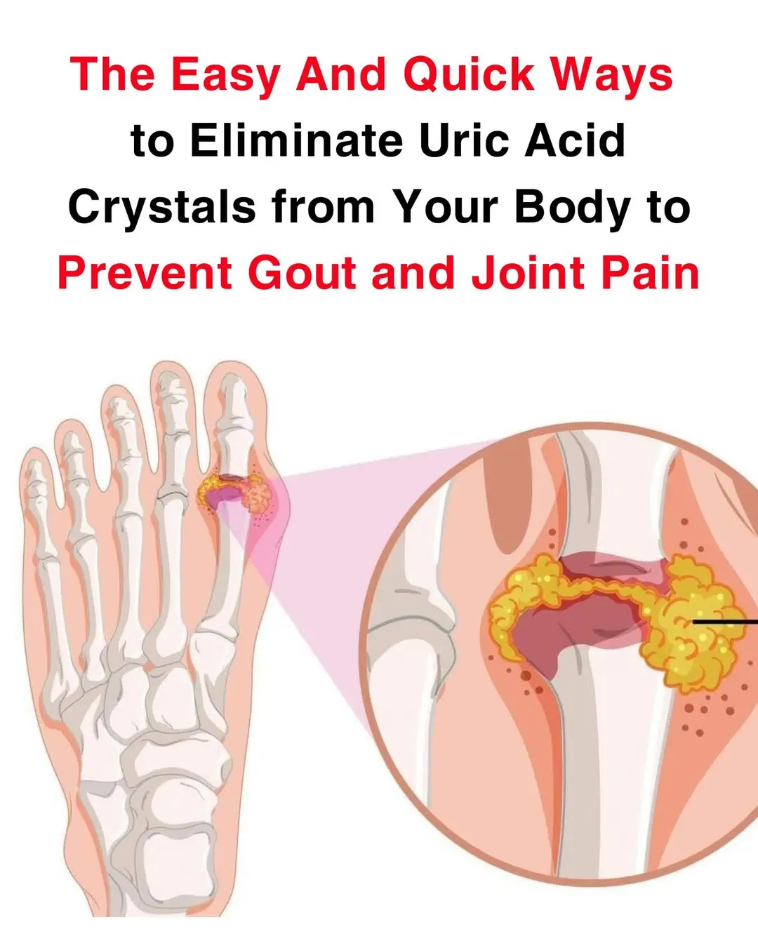 How To Help Naturally Reverse Gout And Relieve Joint Pain