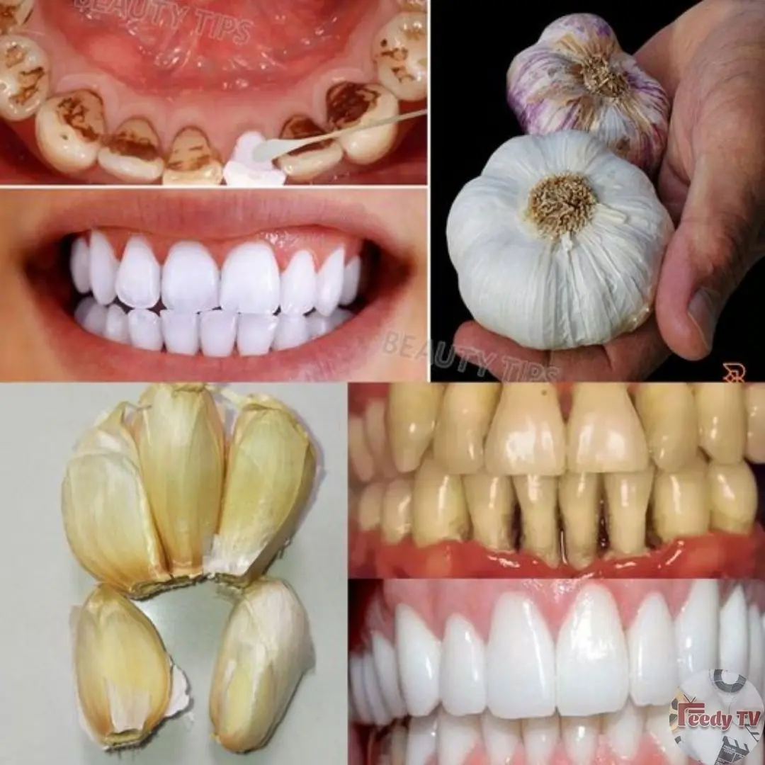 Secret that Dentists don’t want you to know: Remove Tartar and Teeth Whitening in just 2 minutes