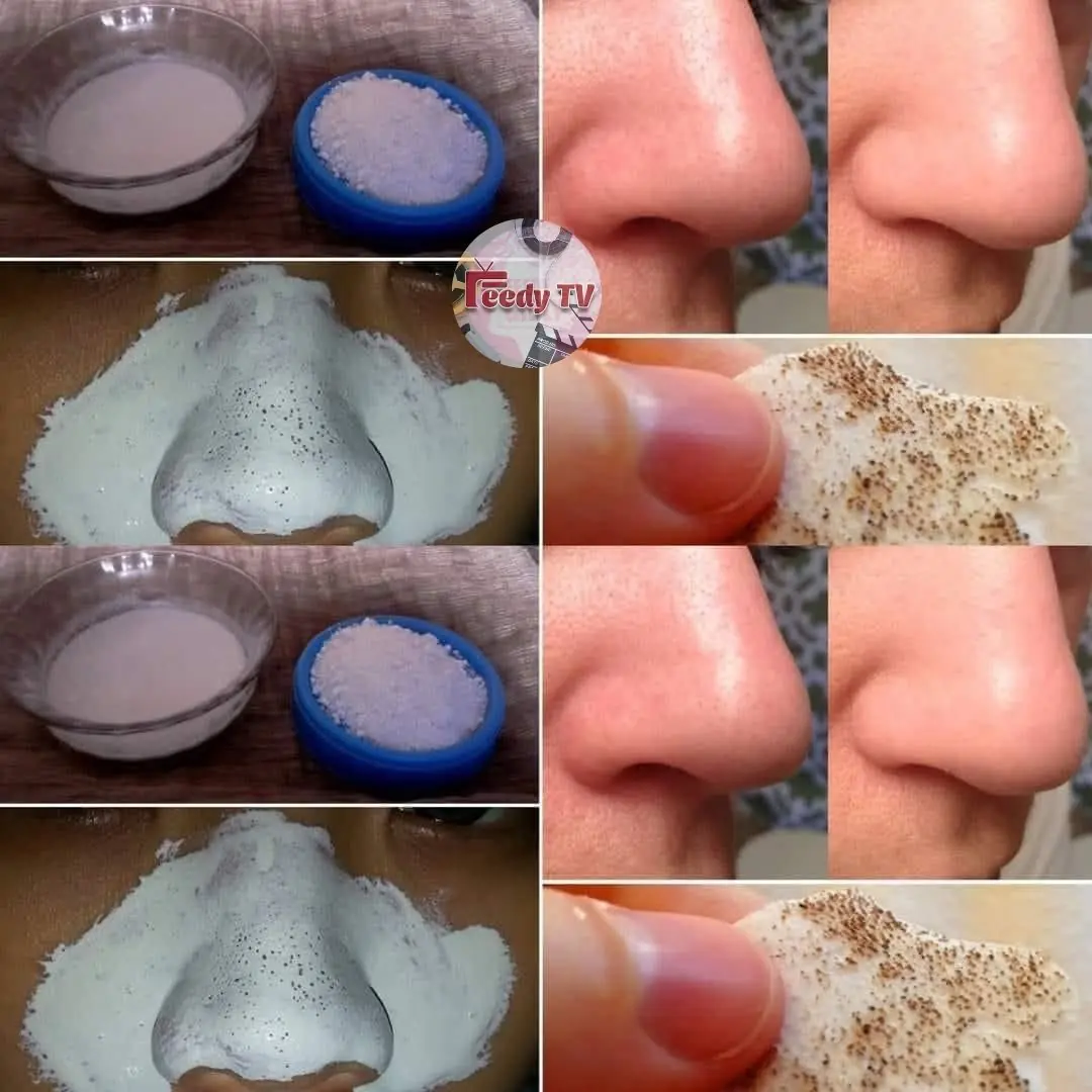 How to Remove Blackheads Naturally