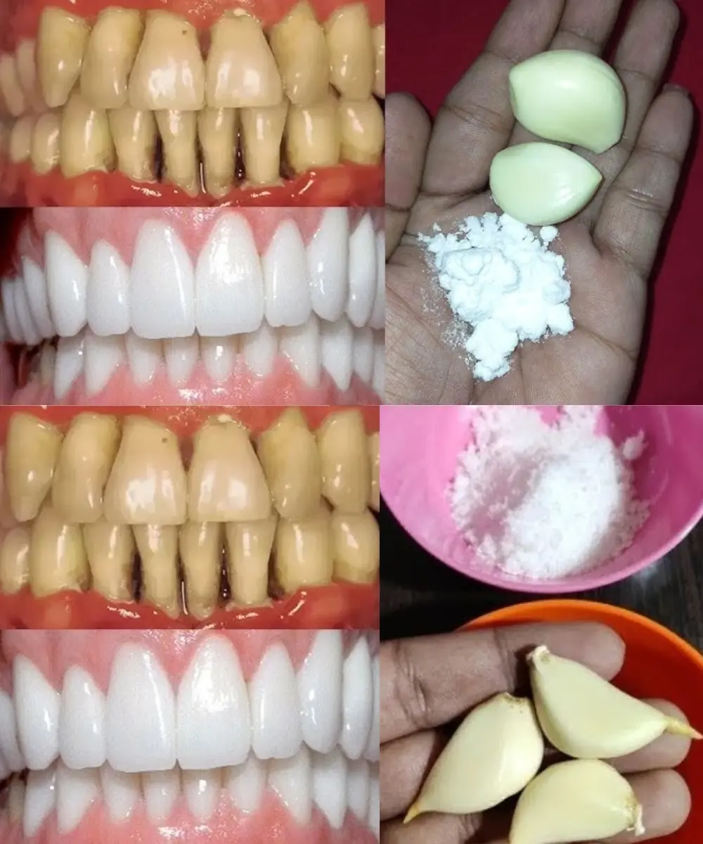 Teeth Whitening at Home in 2 Minutes! Naturally Whiten Yellow Teeth with Garlic & Salt (100% Effective!)