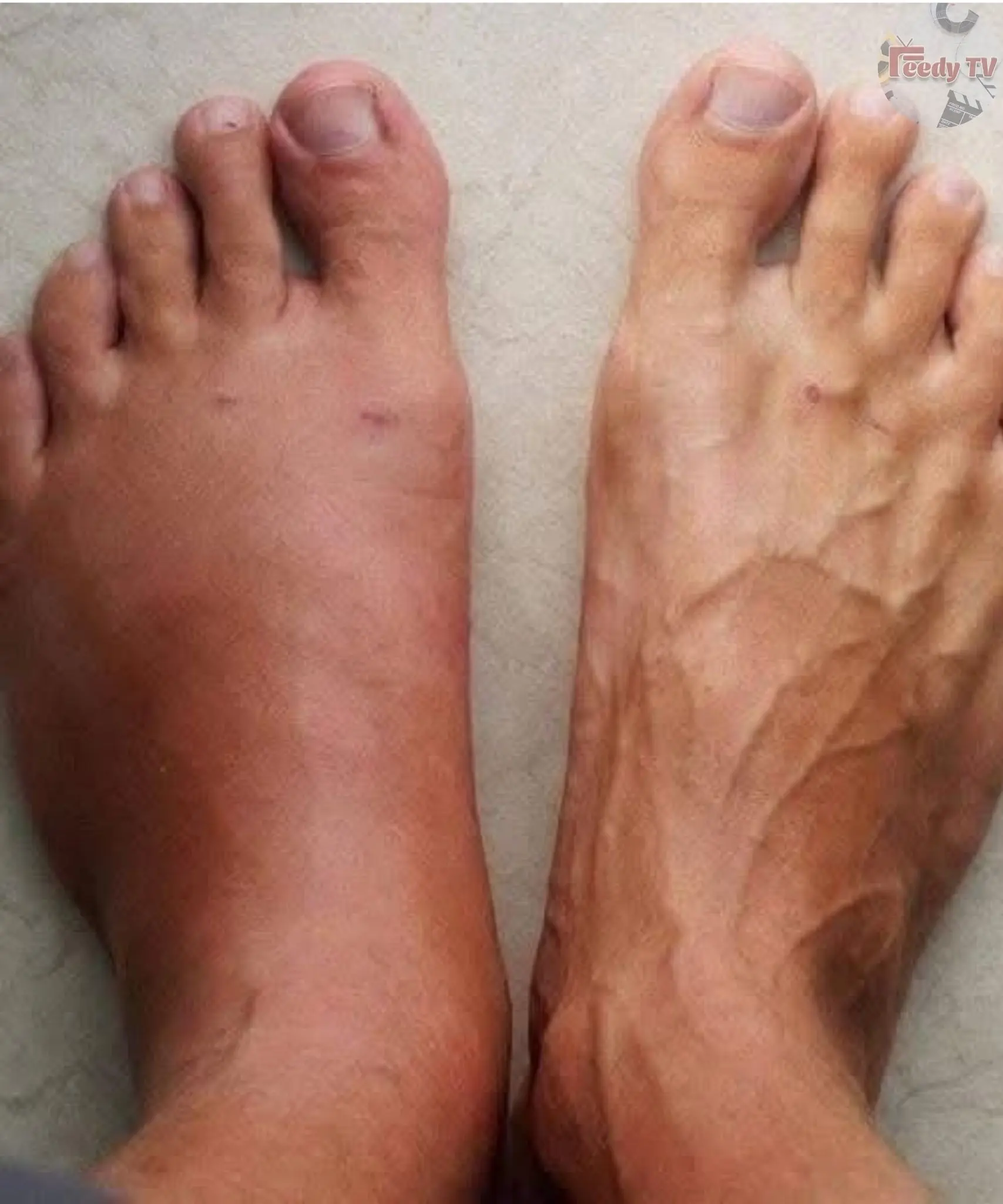 Heart Attack: Early Warning Signs