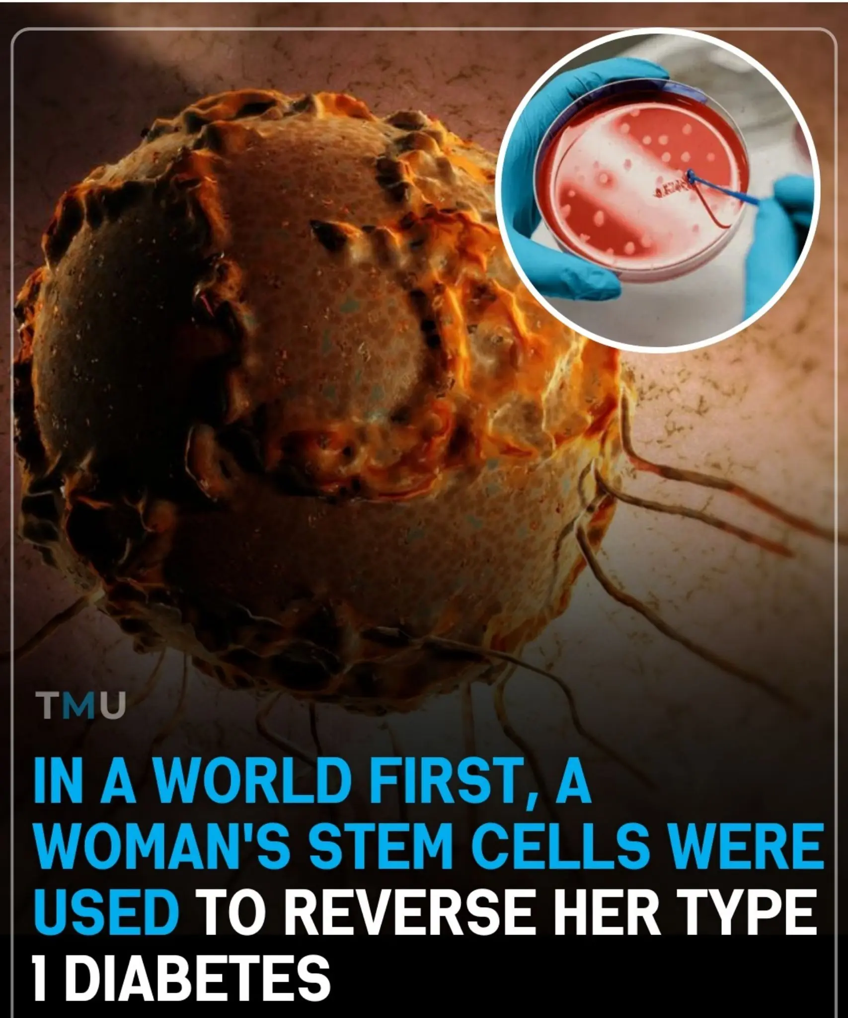 In A World First, A Woman&rsquo;s Stem Cells Were Used To Reverse Her Type 1 Diabetes.