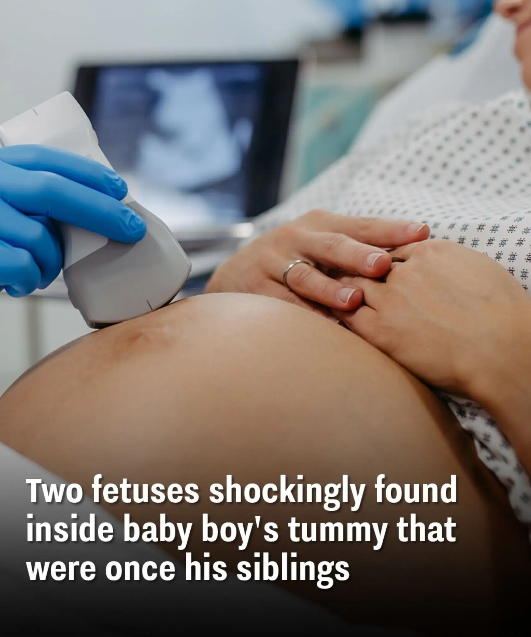 Two fetuses shockingly found inside baby boy's tummy that were once his siblings