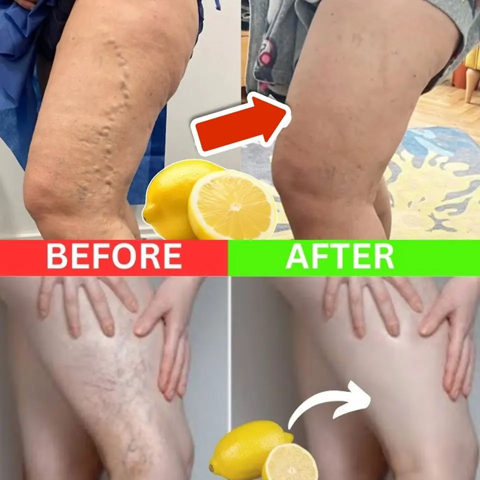 The Natural Power of Lemon in Relieving Varicose Veins