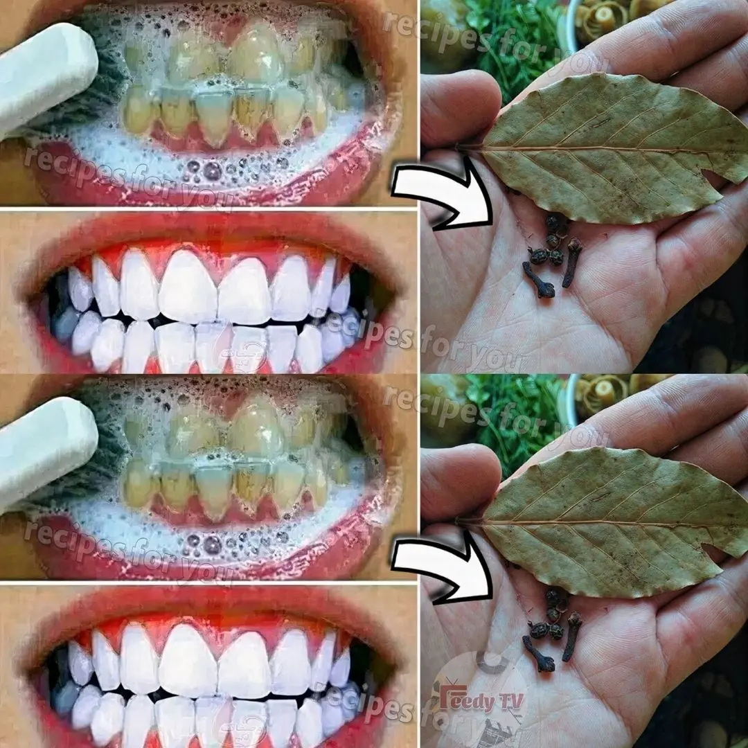 How Brightening Teeth with Bay Leaves Can Say Goodbye to Your Yellow Teeth