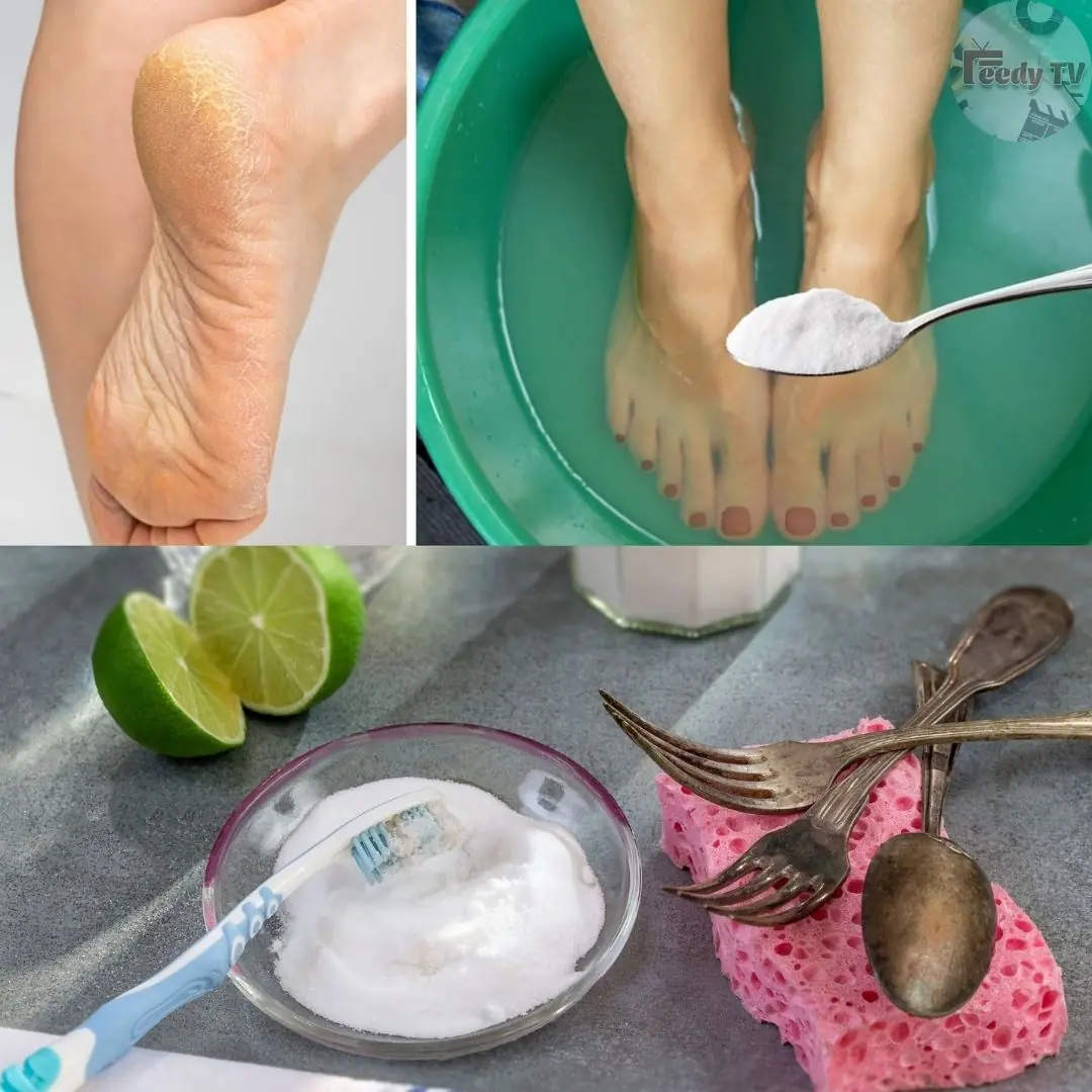 Get Rid of CRACKED HEELS Permanently – Magical Home Remedy