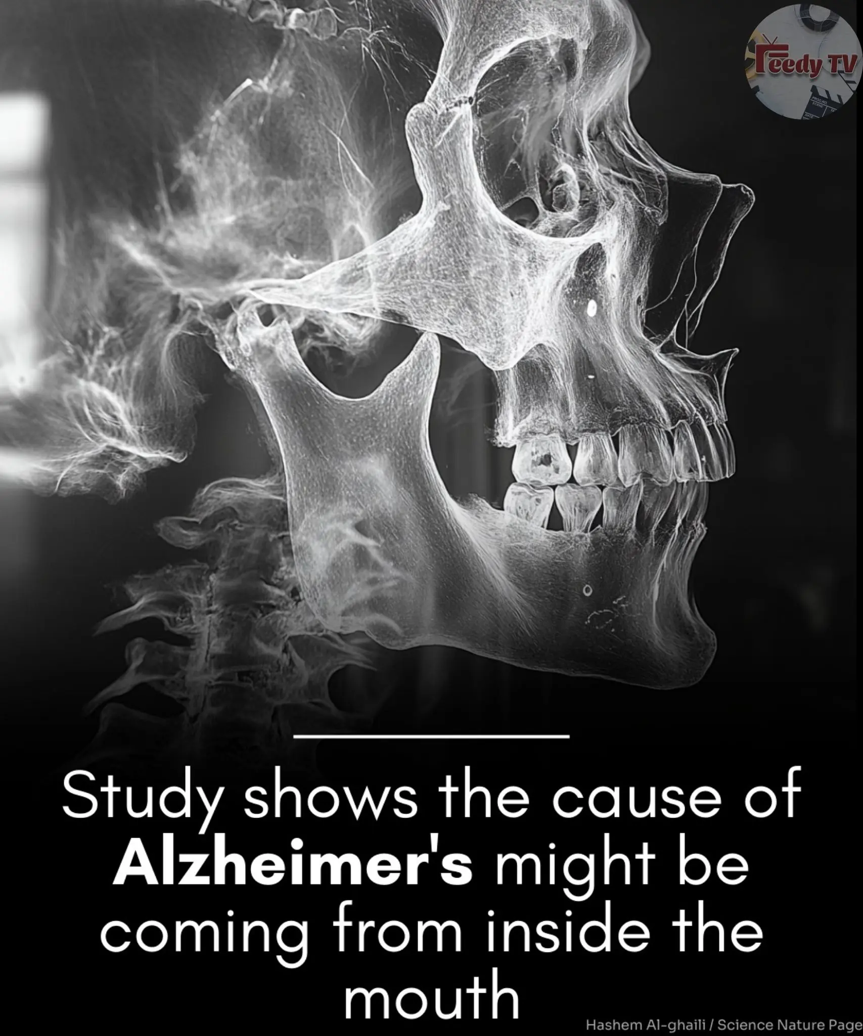 Porphyromonas gingivalis in Alzheimer’s disease brains: Evidence for disease causation and treatment with small-molecule inhibitors