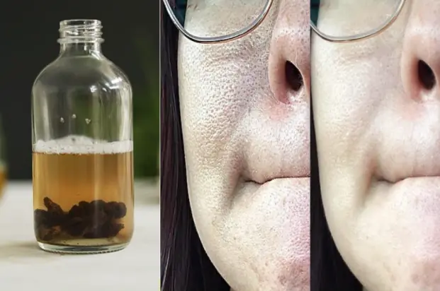 Get Rid Of Large Pores In 4 Steps, Naturally!