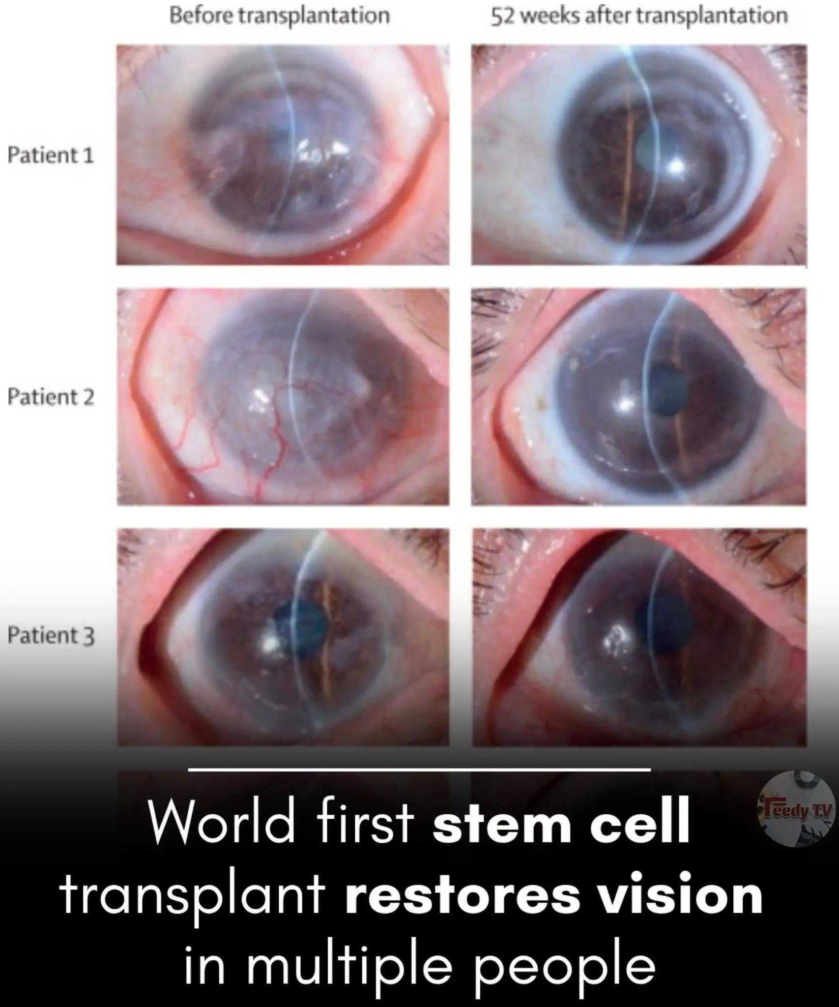 Induced pluripotent stem-cell-derived corneal epithelium for transplant surgery: a single-arm, open-label, first-in-human interventional study in Japan