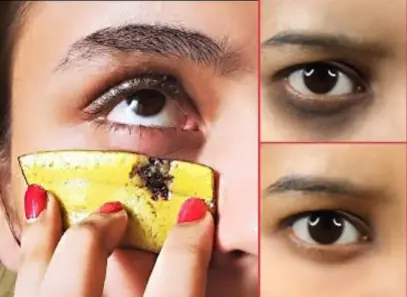 Banana peels for dark circles