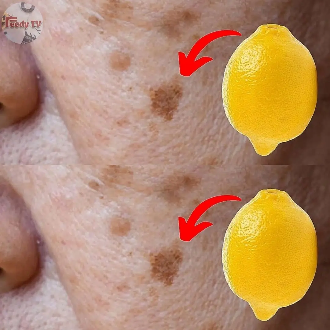 How to Remove Age Spots with Lemons 🤯💥