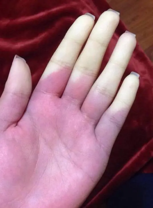 Raynaud’s Phenomenon: Why Fingers Turn White in the Cold