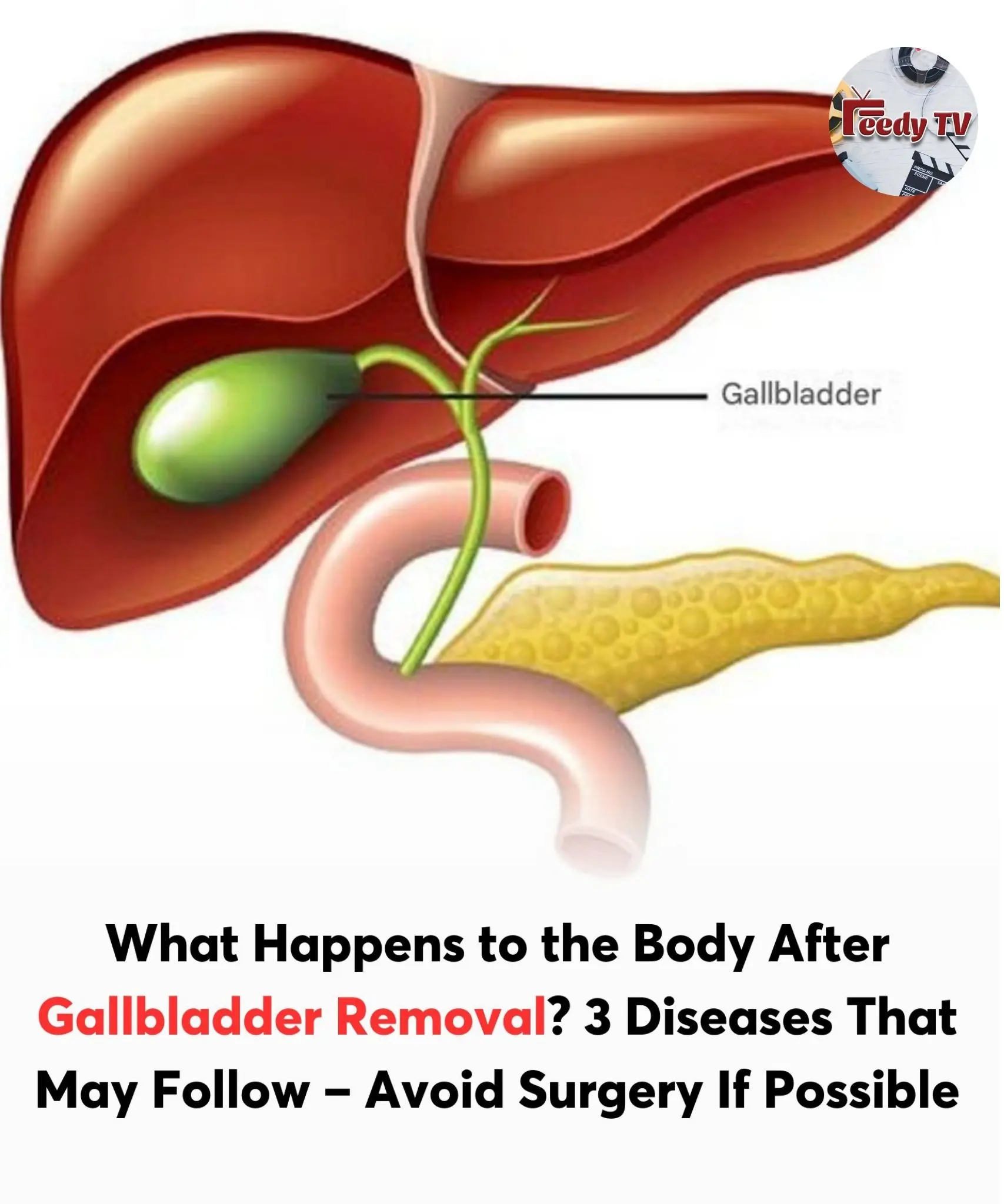 What Happens to the Body After Gallbladder Removal? 3 Diseases That May Follow – Avoid Surgery If Possible