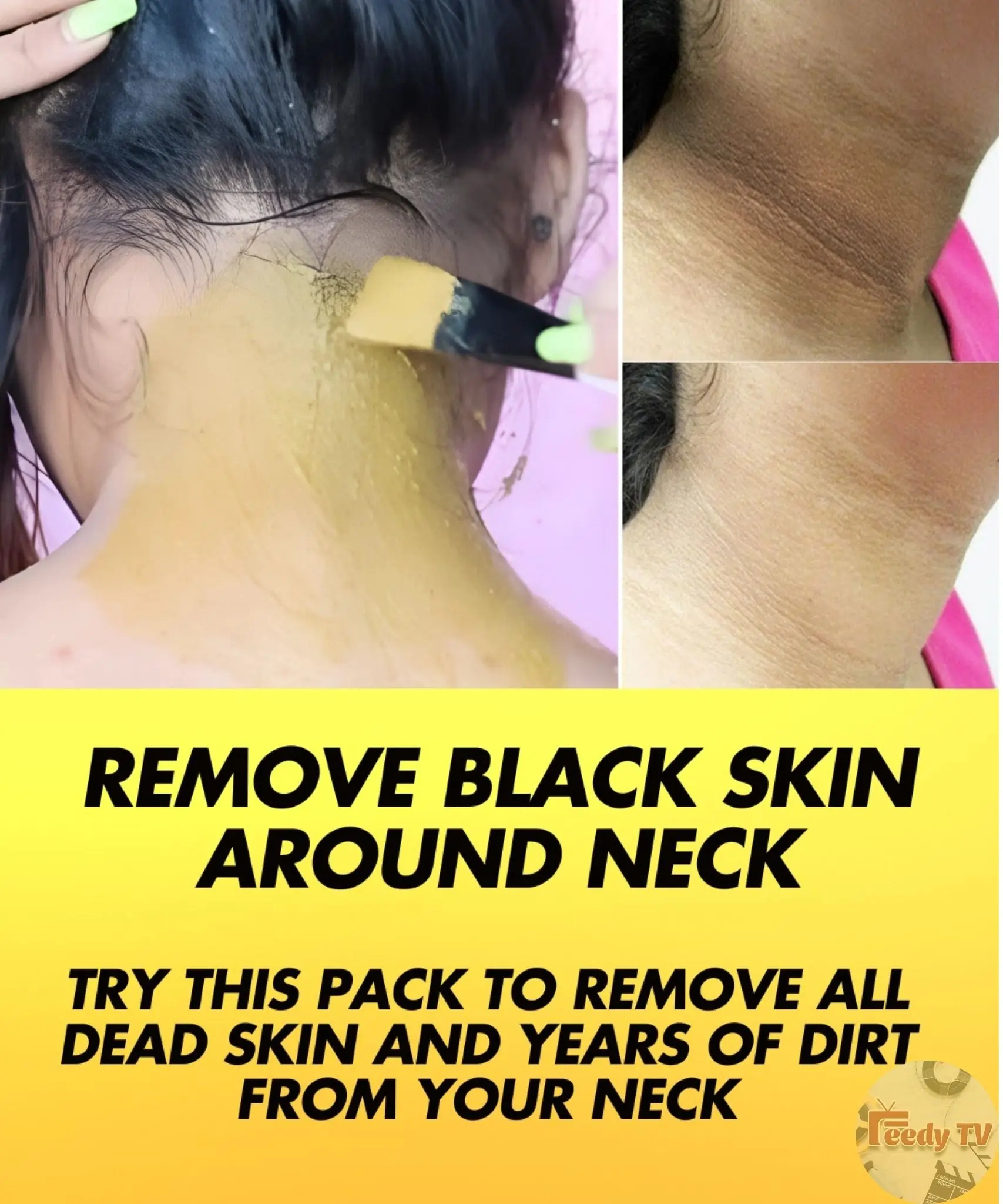 Dark Neck Home Remedies To Get Rid Of It