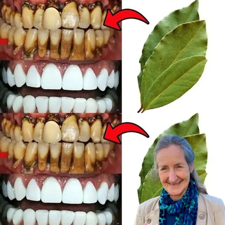 The Secret Dentists Don’t Want You to Know: Whiten Teeth and Remove Tartar in Just 2 Minutes with Cloves and Bay Leaves