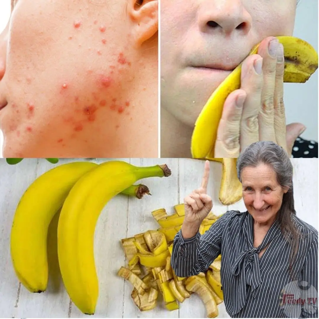 I Rubbed Banana Peel on My Face & My Pimples Are Gone – The Power of the Banana Face Mask