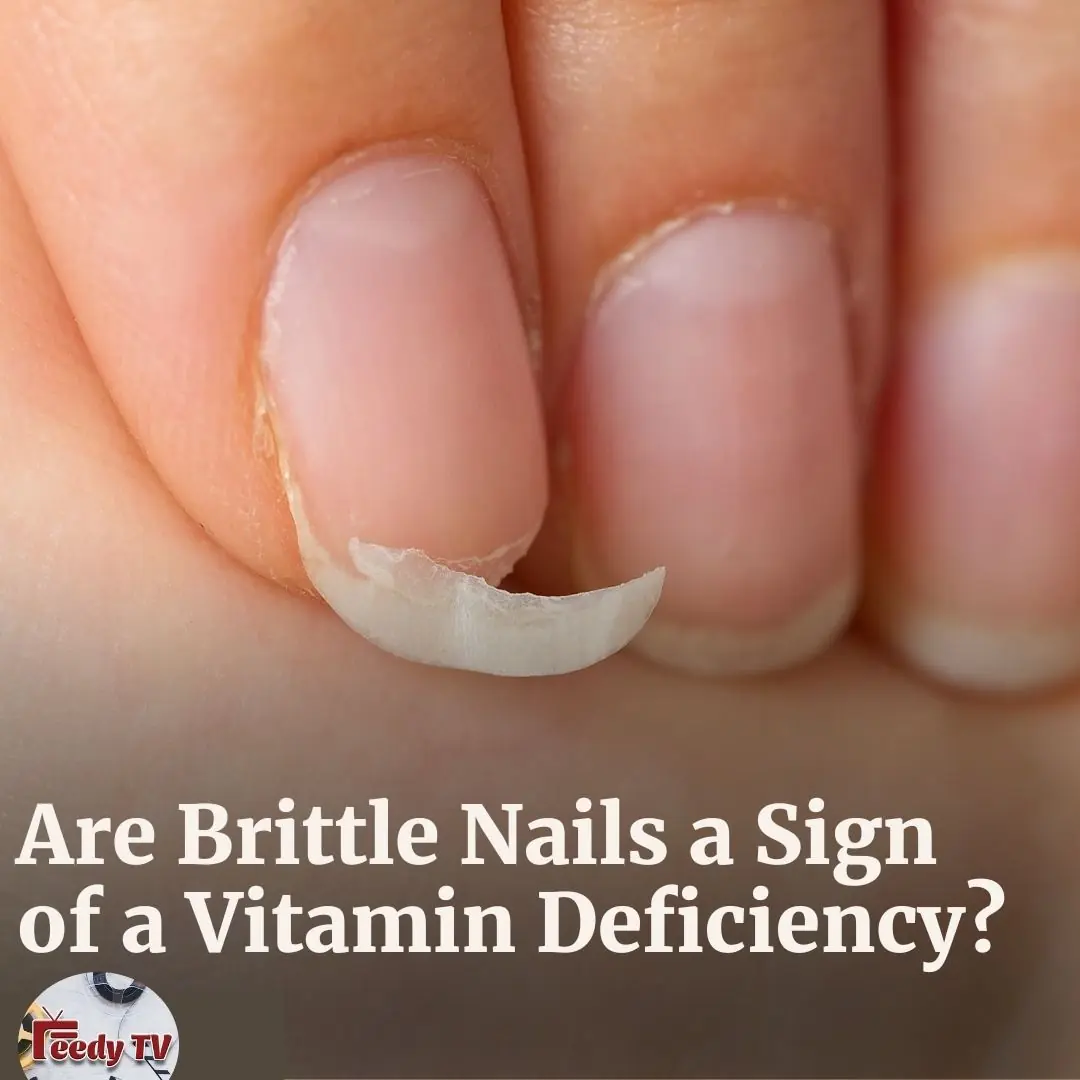 Are Brittle Nails a Sign of a Vitamin or Mineral Deficiency?