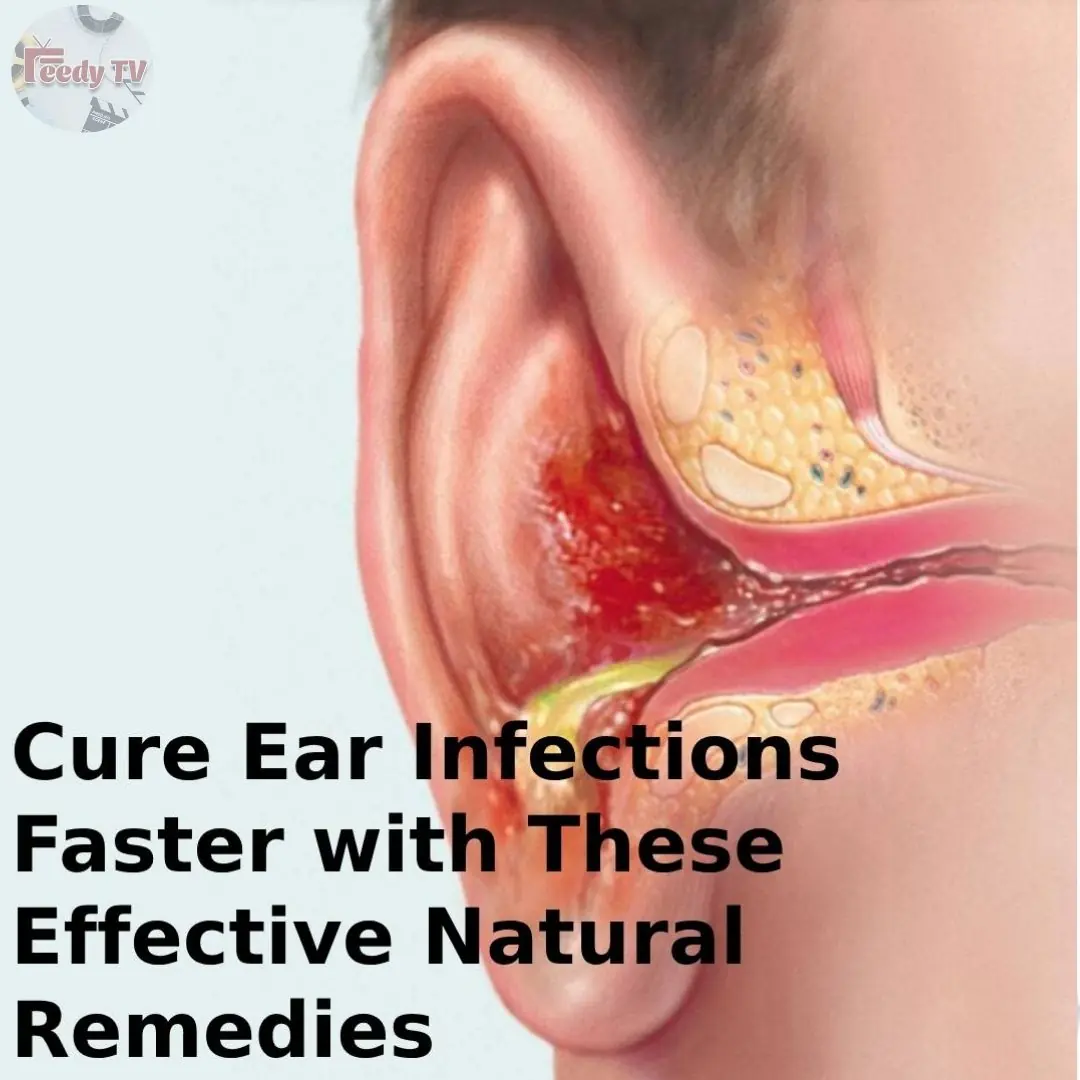 The Best Home Remedies For Getting Rid of Ear Infection