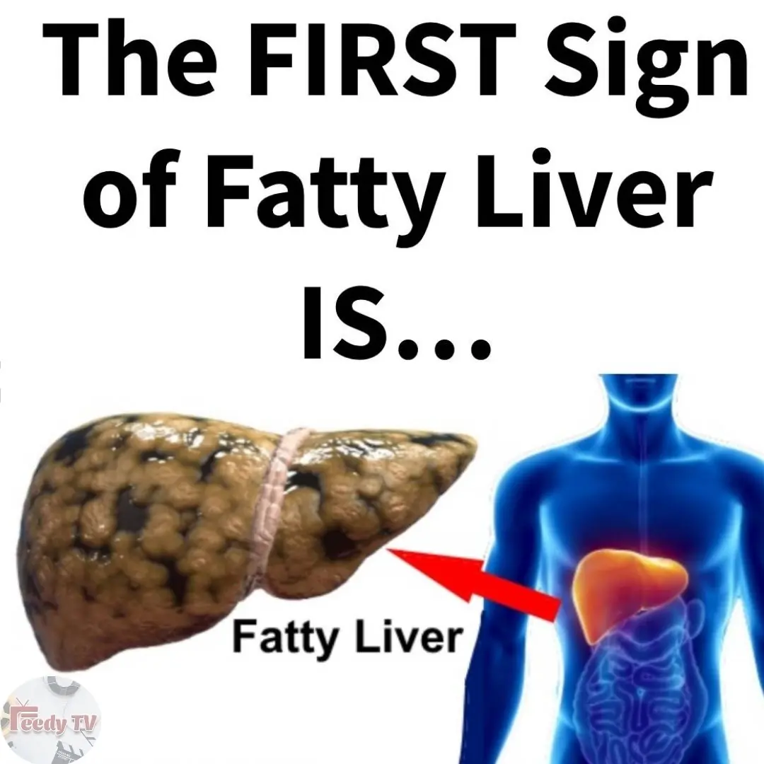 ealth Food & Nutrition Beauty Aromatherapy Animals Fatty Liver (Hepatic Steatosis): Signs, Symptoms and How to Prevent It (Backed by Studies)