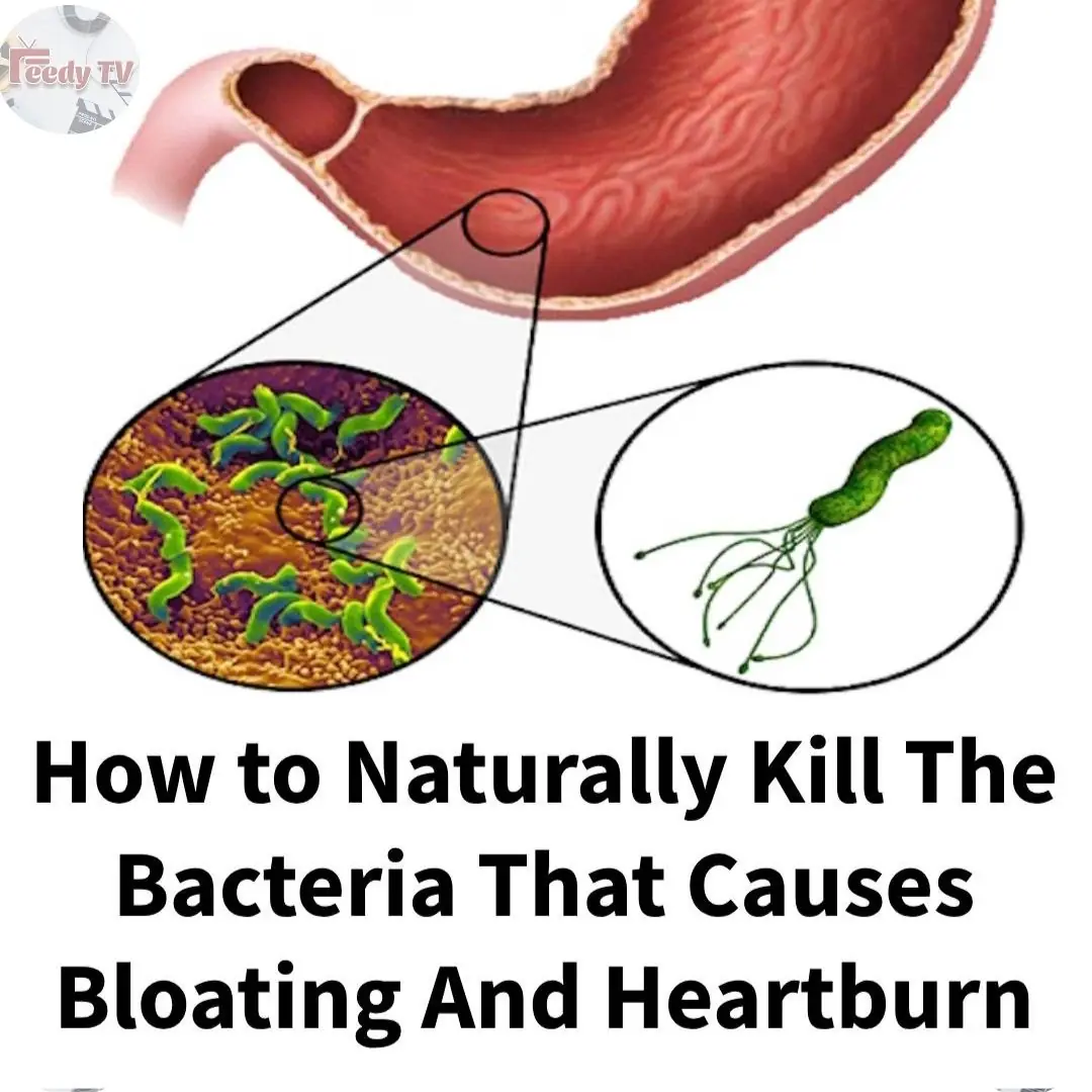 How to Treat H. Pylori (Helicobacter Pylori) Naturally Without Antibiotics