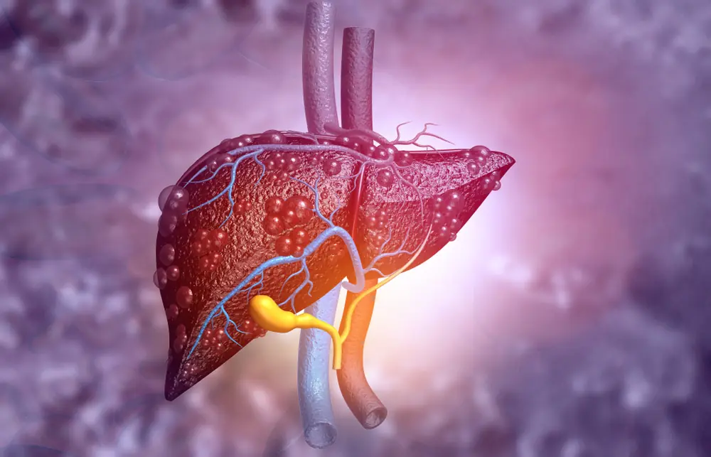 Fatty Liver: Causes, Symptoms, Types, Prevention, and Lifestyle-Based Management