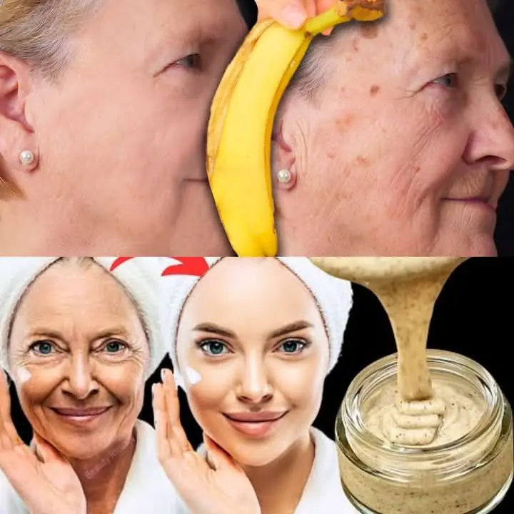 Banana Skin: Effective Ingredient To Remove Pimple Dark Spots