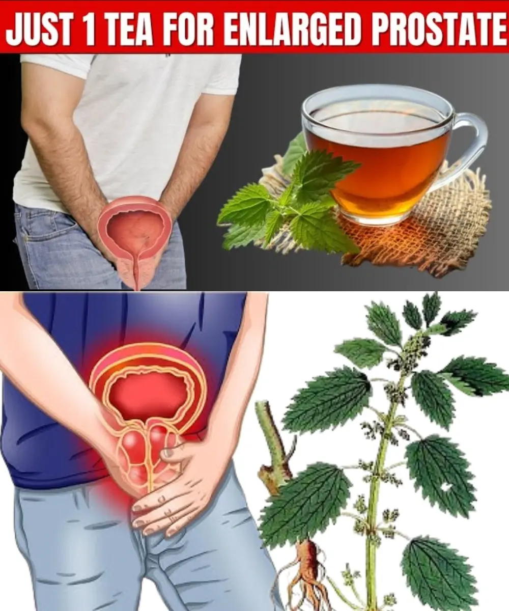 Nettle for Prostate Health: Detailed Recipe, Tips, and Symptoms