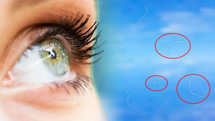 What Are Eye Floaters? Here What To Do If you Start Seeing Them, According to an Eye Doctor