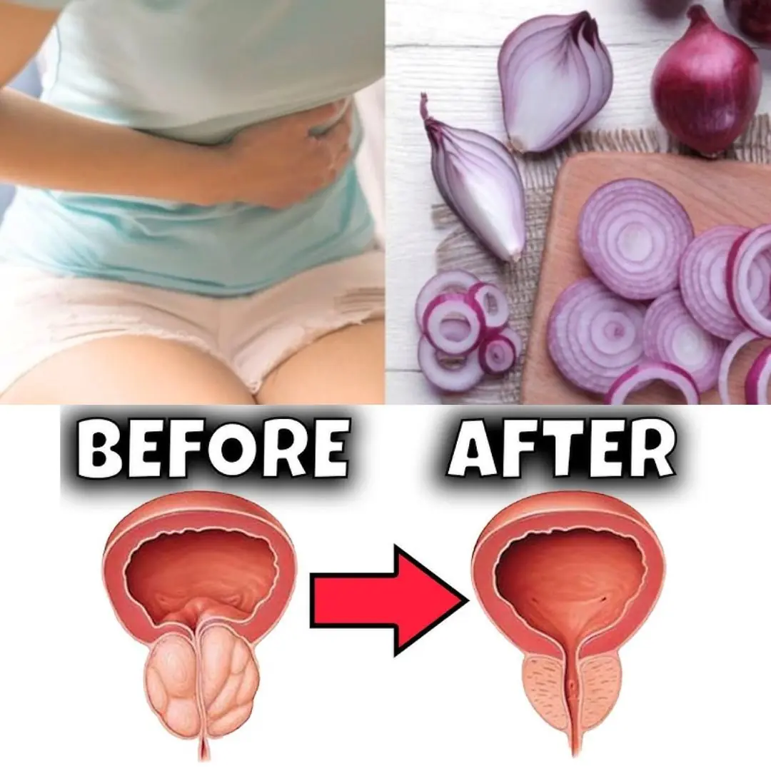 Natural Home Remedies: Onion and Onion Peel for Bladder and Prostate Health