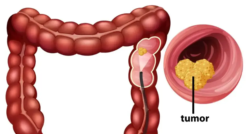 How Your Bowel Movements Reveal Clues About Colon Cancer