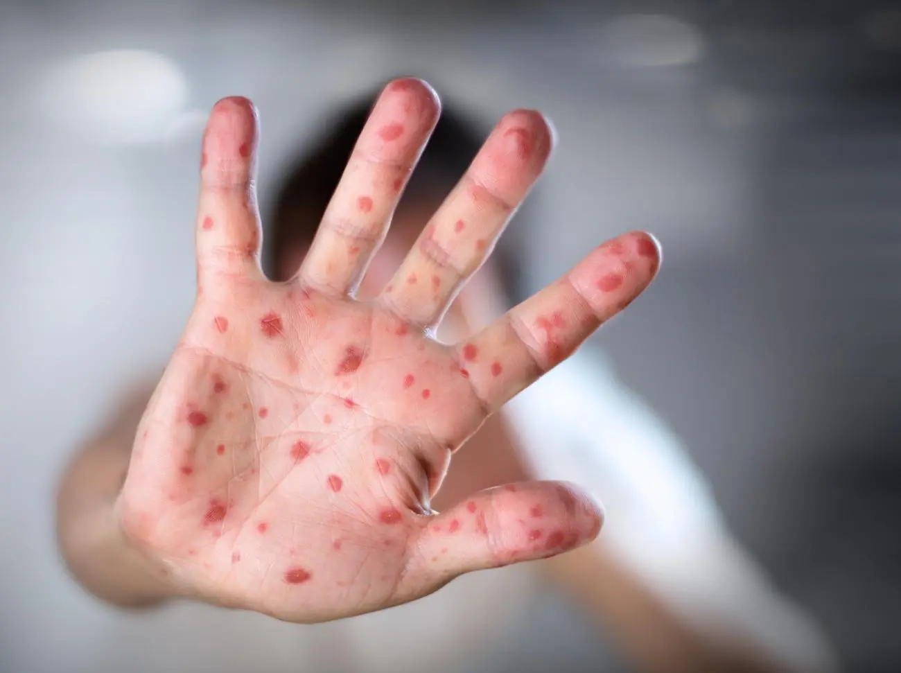 What You Need to Know About Measles