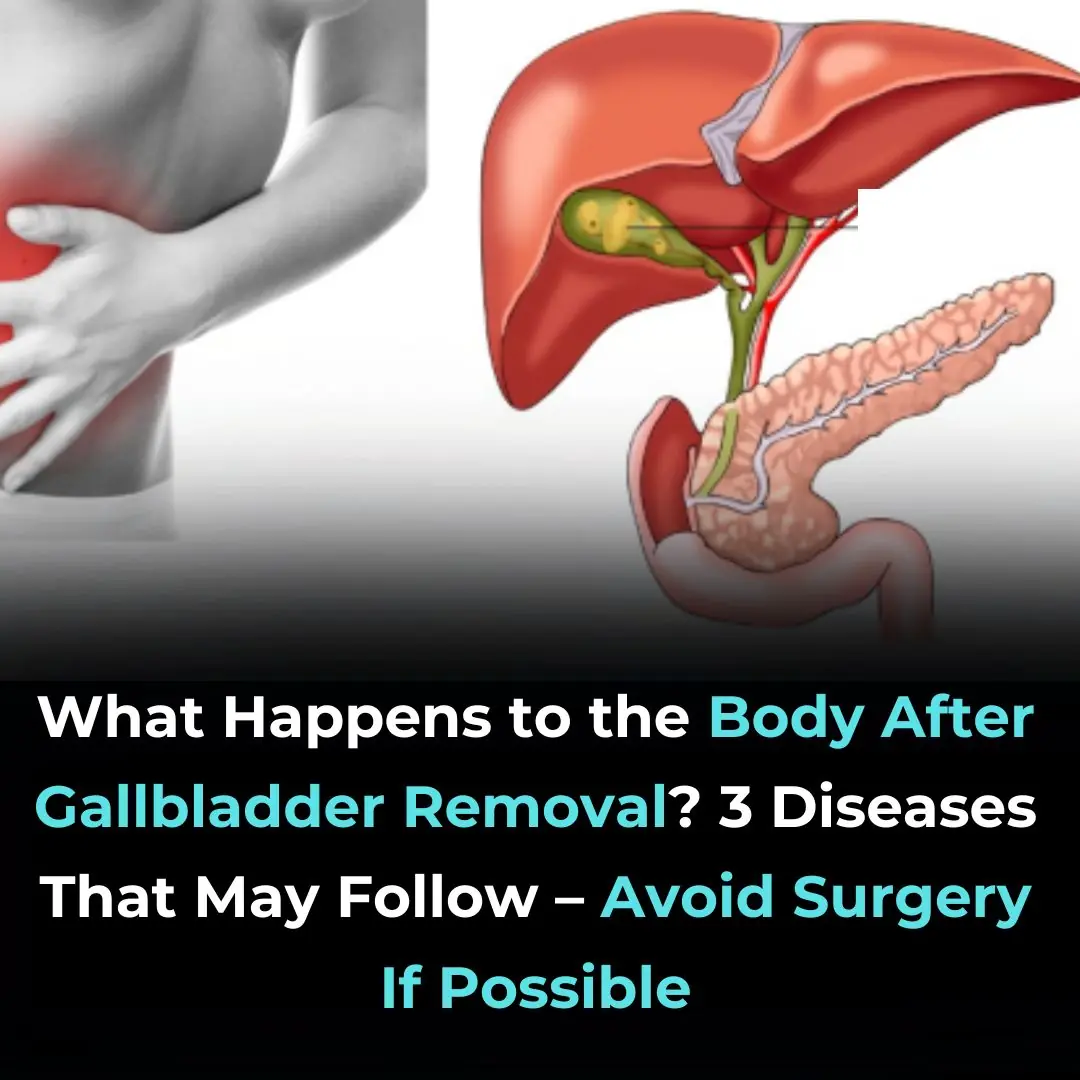 What to Expect After Gallbladder Surgery: Side Effects and Dietary Tips