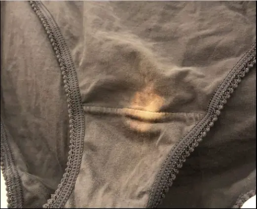 What a “Bleach” Patch on Your Underwear Means