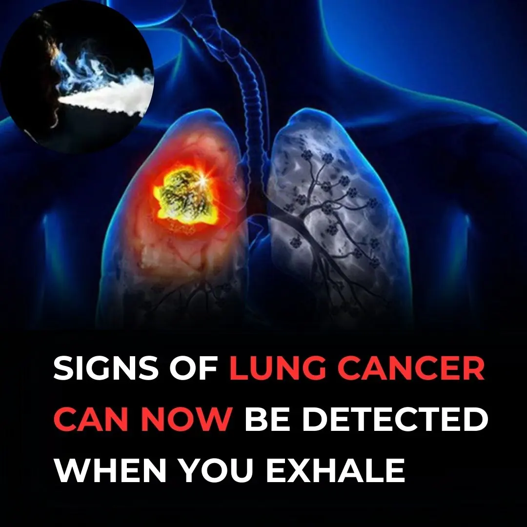 What Happened - Scientists have developed technology that can detect lung cancer through simple breath tests.