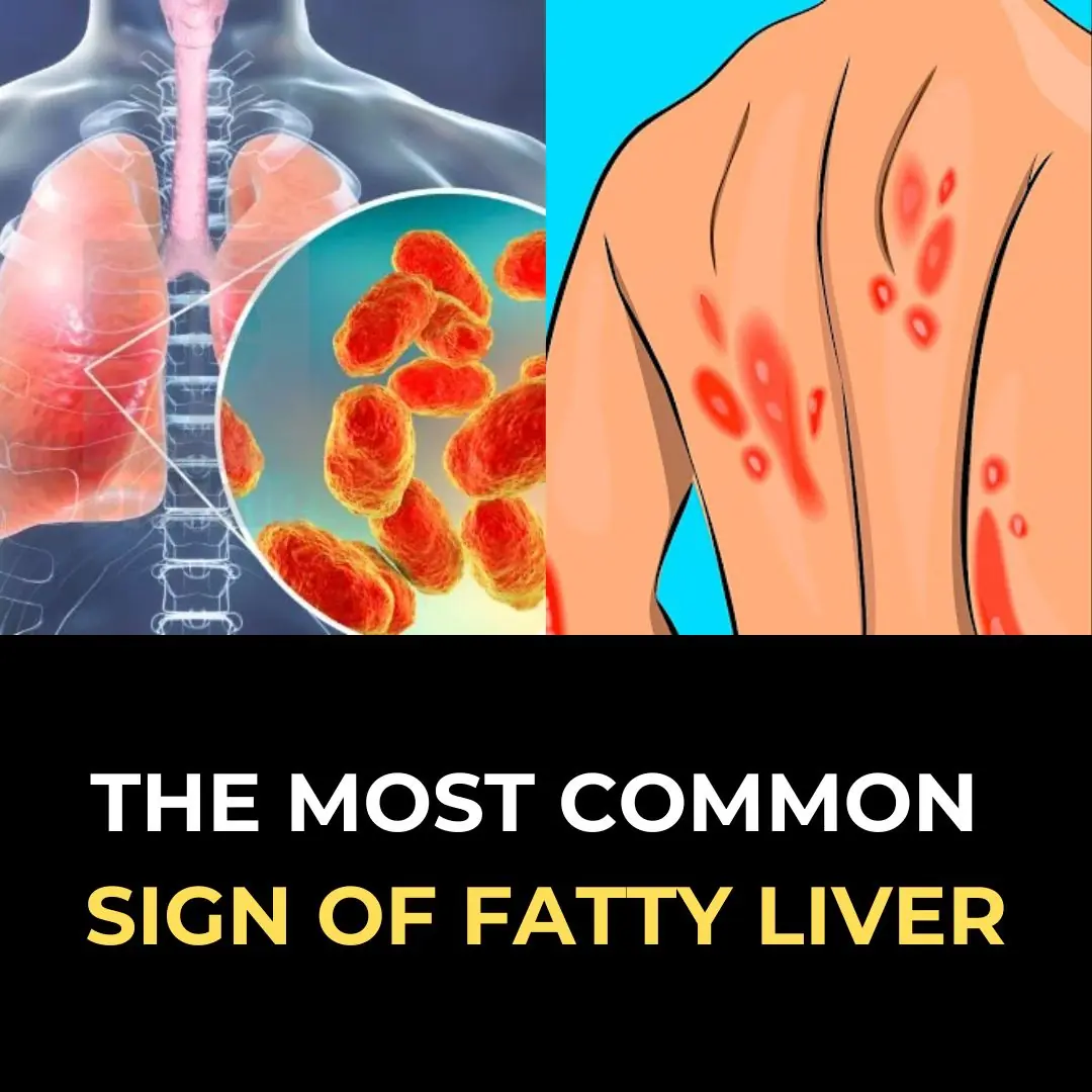 Fatty Liver: Causes, Symptoms, Treatment & Home Remedies