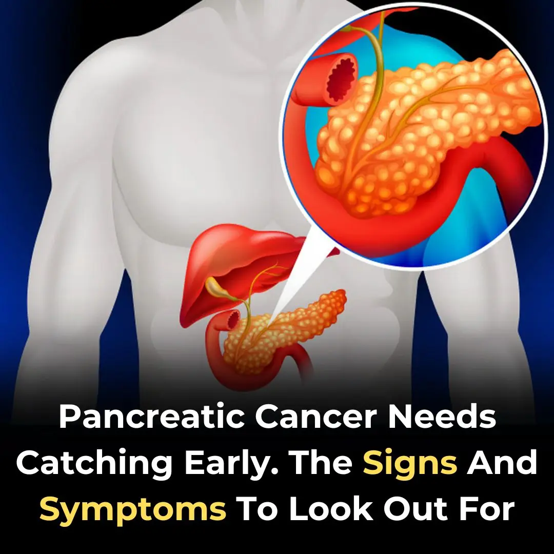 10 Signs of Pancreatic Cancer You Should Never Ignore