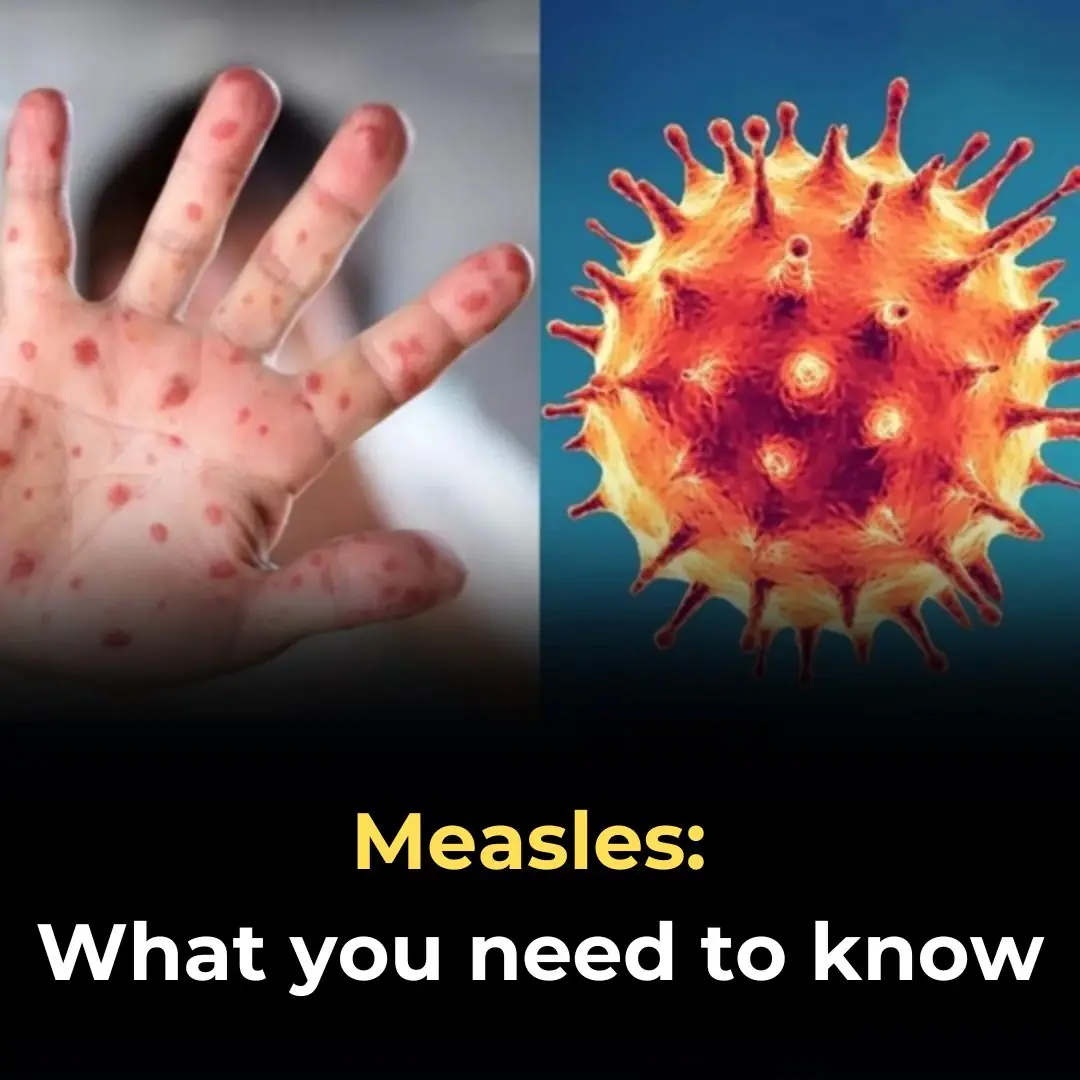 What You Need to Know About Measles