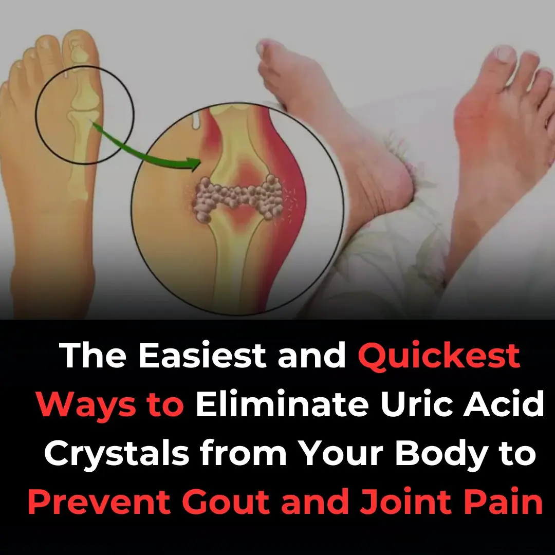 10 Foods That Cause Gout Flare Ups