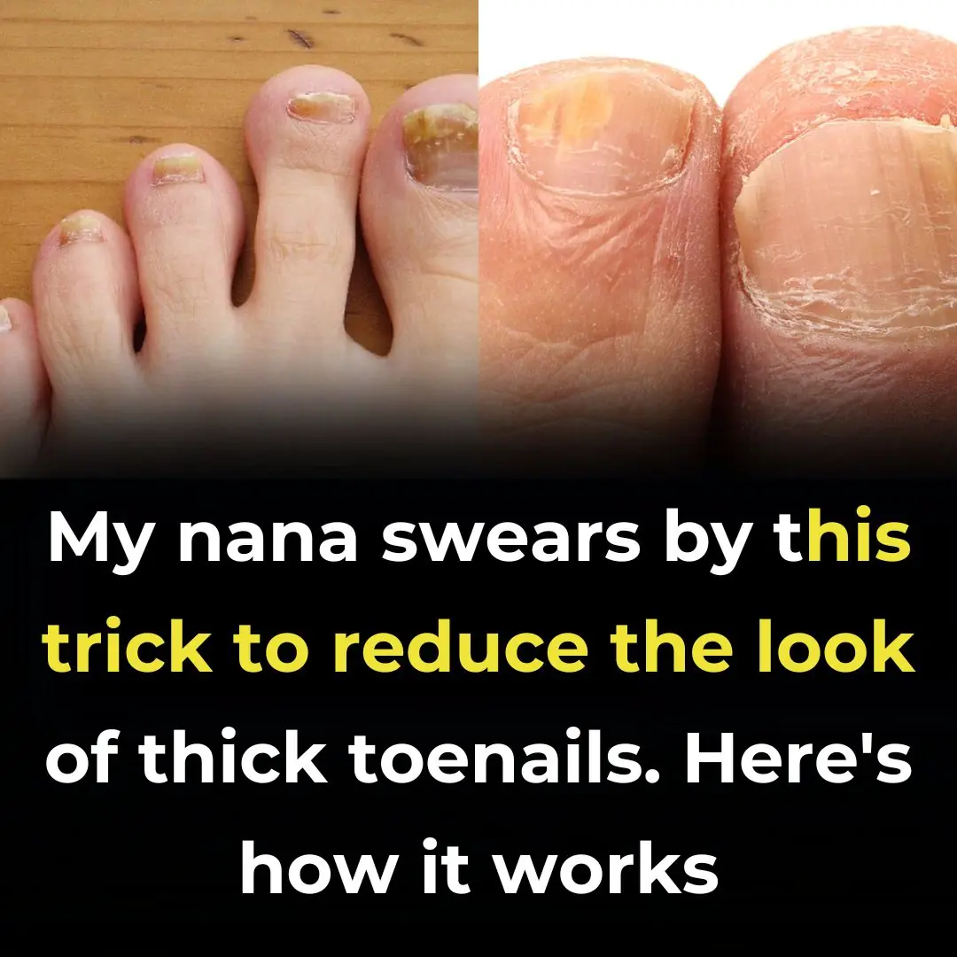 Thick Toenails: Treatments and Home Remedies