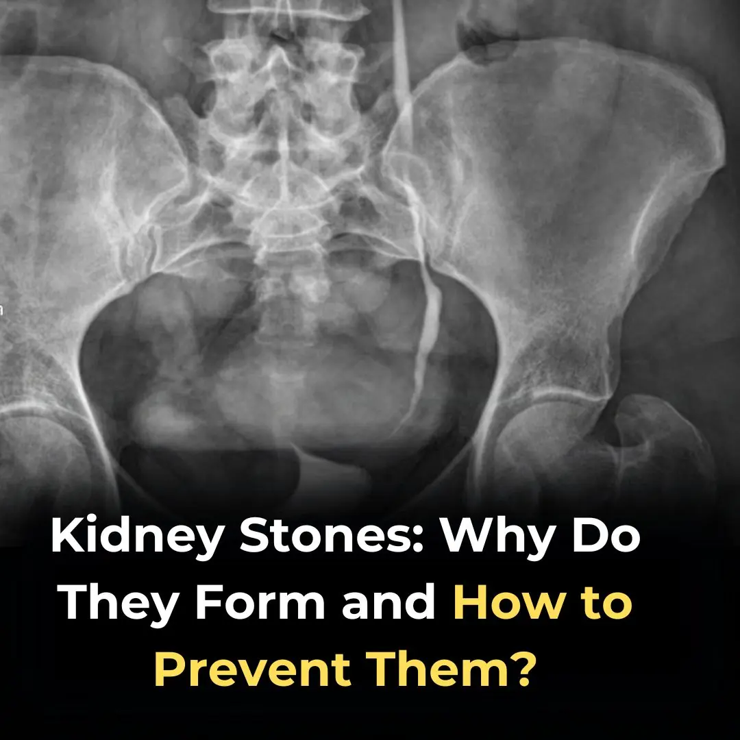 Kidney Stones: Why Do They Form and How to Prevent Them?