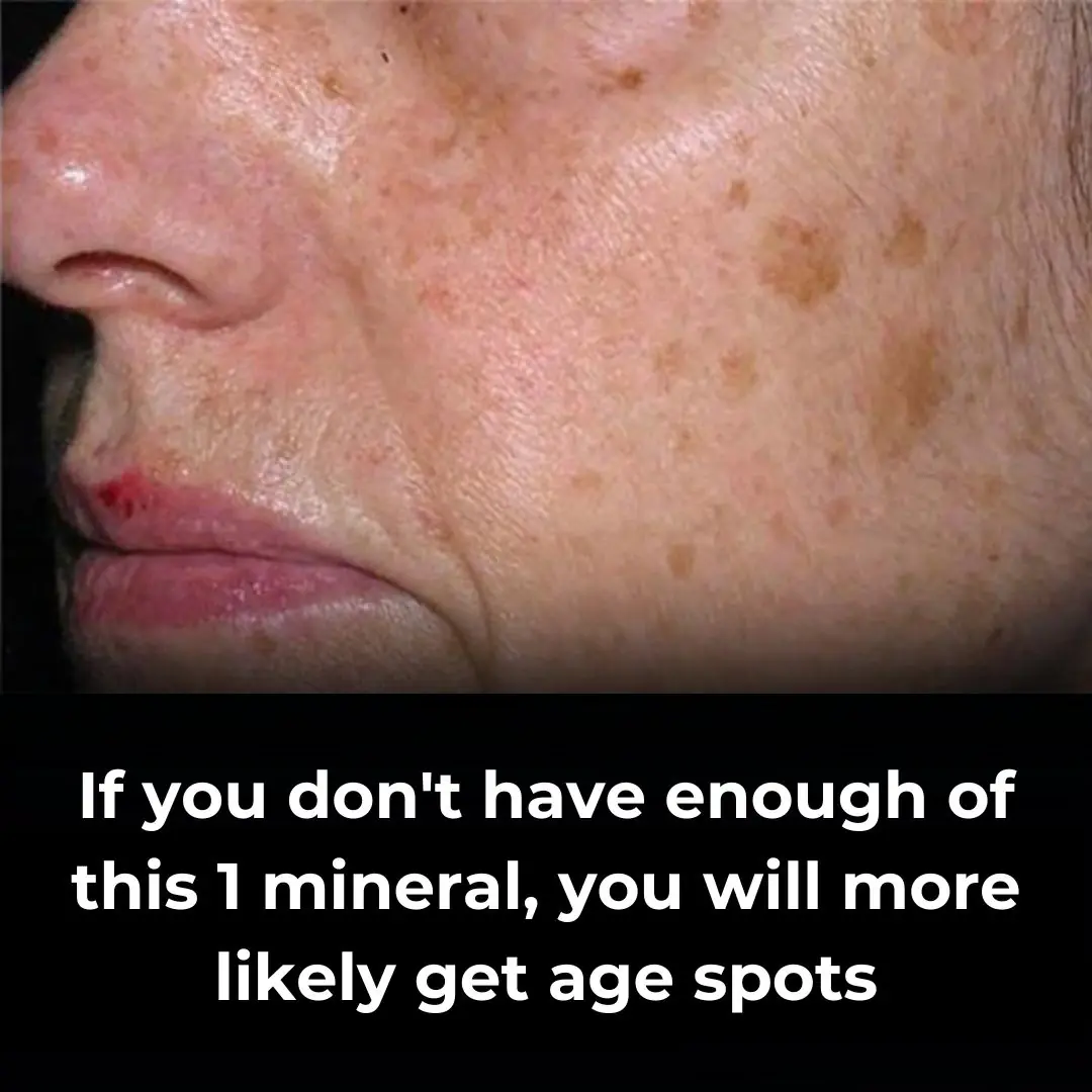 How To Reduce Age Spots: Causes, Treatment, and Prevention