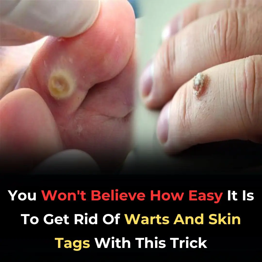 **Say Goodbye to Skin Tags and Warts: Easy Removal with Hydrogen Peroxide**