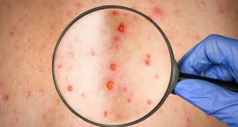 This is What Measles Does to Your Body