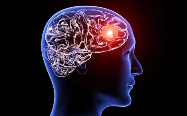 Aneurysm: Signs You Shouldn't Ignore