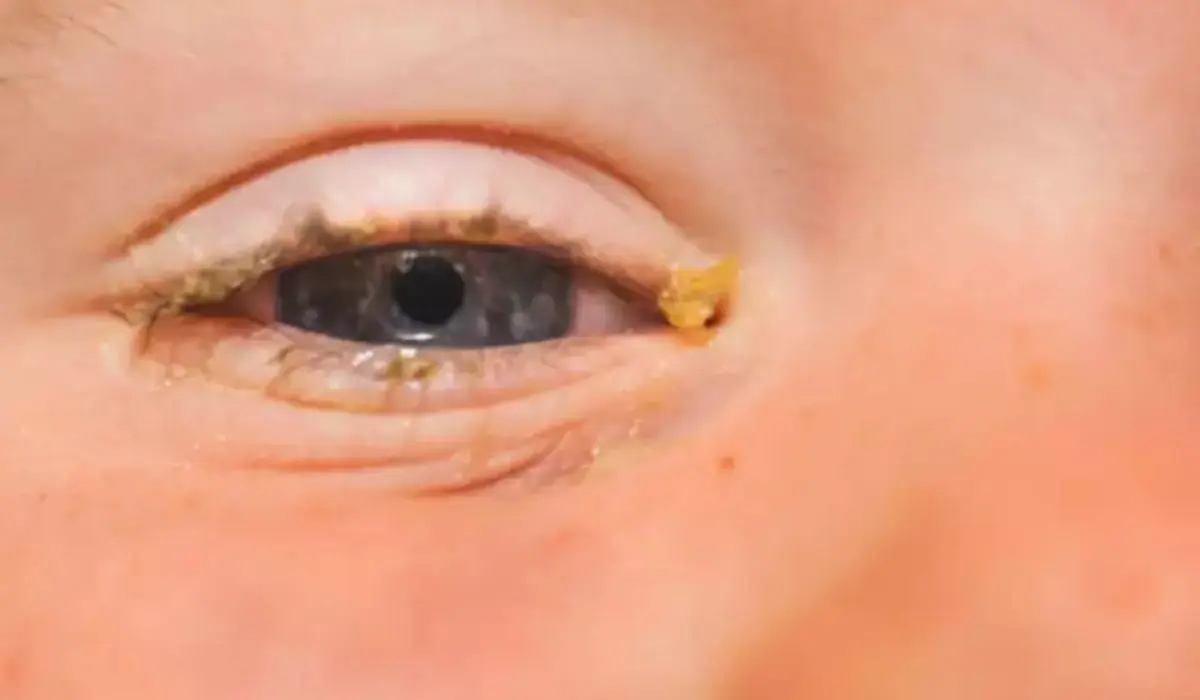 The science behind eye ‘sleep:’ What that crust really is