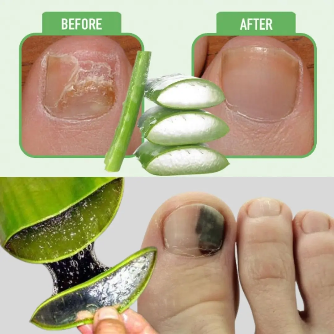 Aloe Vera: A Natural Remedy for Nail Fungus 🌿💅