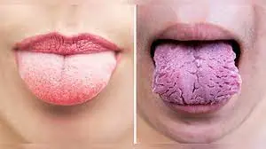 What Your Tongue Says About Your Health
