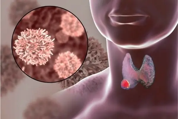 7 Early Warning Signs of Nasopharyngeal Cancer: Even One Symptom Is a Reason to See a Doctor