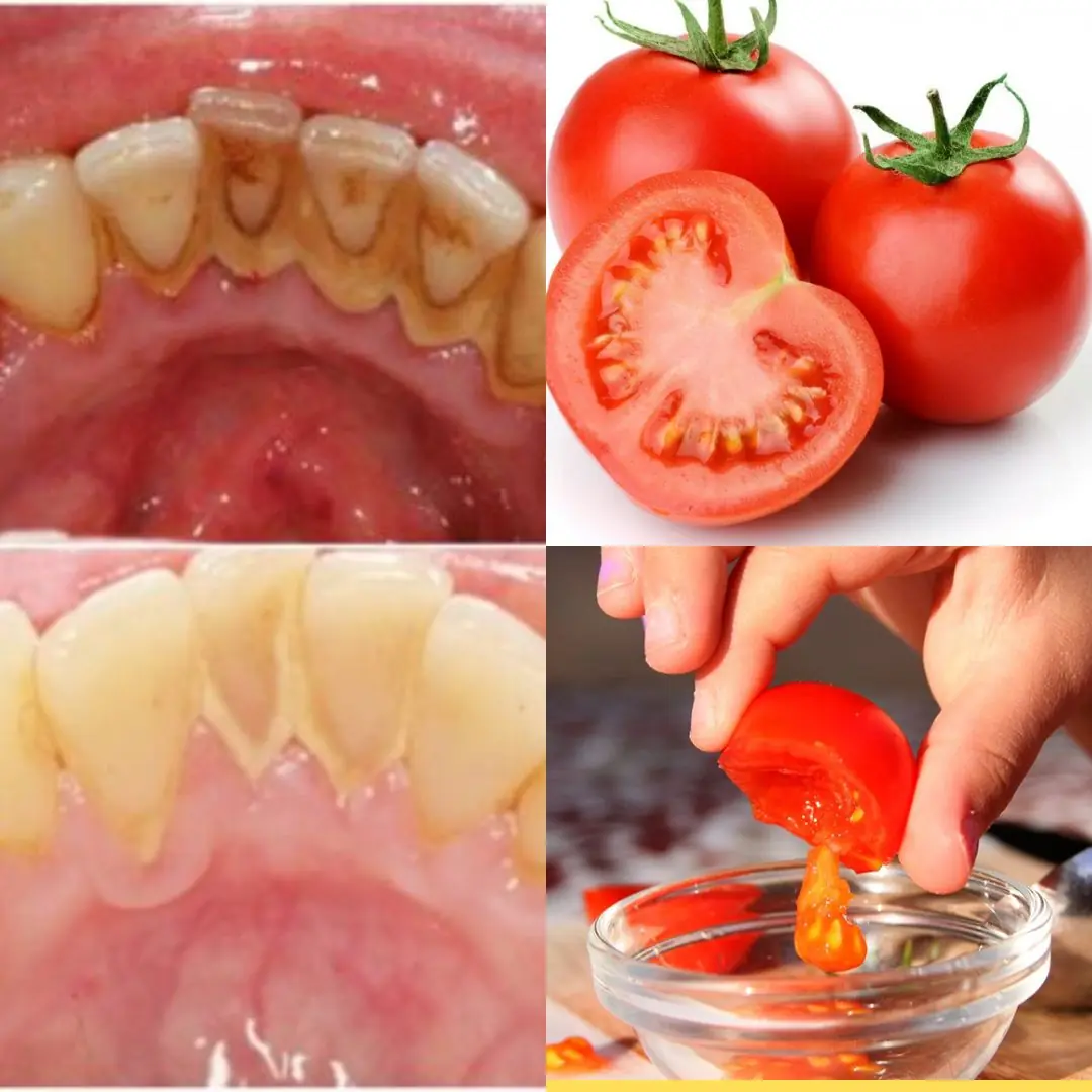 The Strongest Teeth Whitening Recipe at Home in 2 Minutes: Whitening Yellow Teeth from Tartar Naturally with Tomatoes and… 🍅✨
